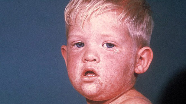 BabyMeasles