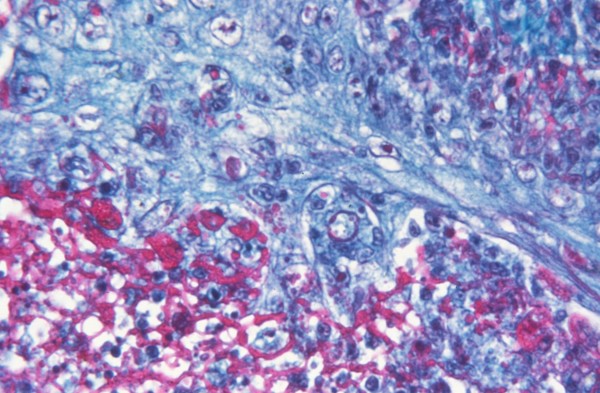 smallpox infection