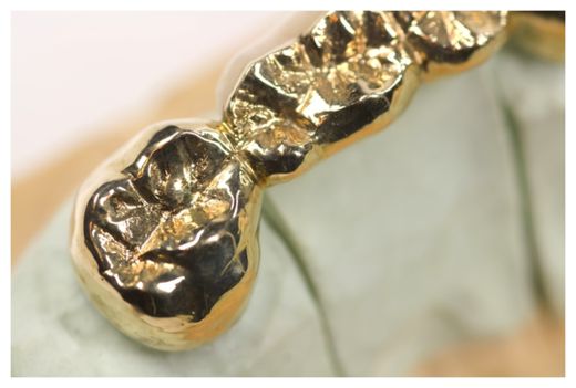 Gold Teeth