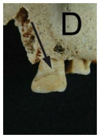 Click to enlarge Ancient dental calculus