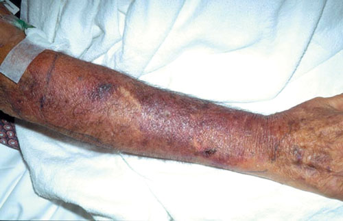 Vibrio infection